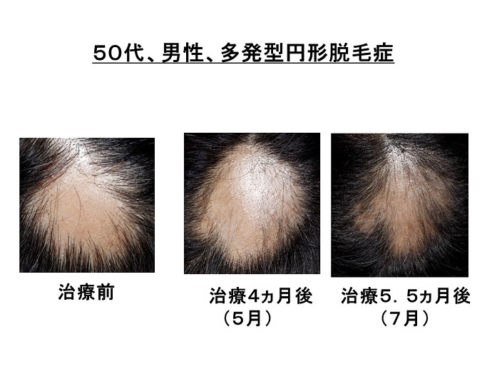 円形脱毛症　病院